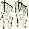 Ампутация пальцев стопы