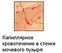 Реферат: Хронический пиелонефрит Тубулоинтерстициальный нефрит