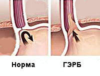 ГЭРБ у детей