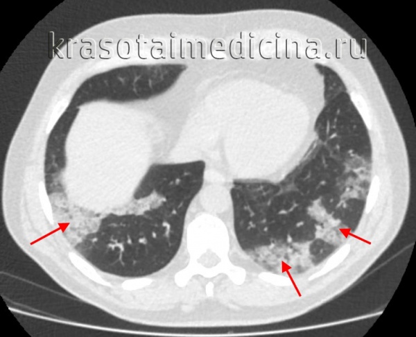 КТ ОГК. Множественные обширные участки снижения пневматизации по типу консолидации в нижних долях обоих легких.