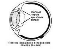 Вывих хрусталика