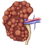 Поликистоз почек