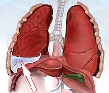 Плеврит: код МКБ 10, симптомы, лечение, прогноз