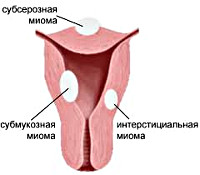 Реферат: Миома матки больших размеров. Хронический эндоцервицит. Ожирение II стадии