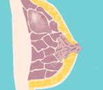 Доброкачественные опухоли молочных желез