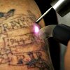 Удаление лазером татуировок