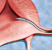 Гистероскопическая стерилизация Essure