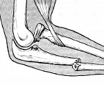 Перелом локтевой кости