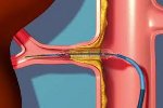 Стеноз почечных артерий