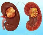 Ангиолипома почки Ангиолипома почки