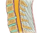 Дискогенная миелопатия
