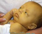 Холестаз новорожденного