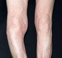 Deformierende Osteitis