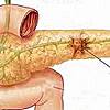Энуклеация опухоли поджелудочной железы