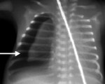 Пневмоторакс у новорожденных