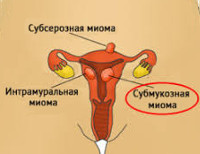 Субмукозная миома матки