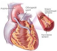 Процедура Аортокоронарное шунтирование (АКШ)