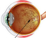 Пигментный ретинит 
