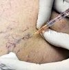 Курс компрессионной склеротерапии варикозных вен