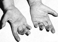 Roussi-Levi-Syndrom