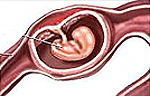 Как лечат синдром внематочной беременности? Внематочная беременность в яичнике: симптомы, диагностика и лечение
