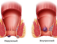 Геморрой