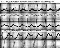 Пароксизмальная тахикардия у детей
