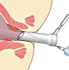 Склеротерапия геморроидального узла