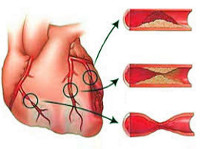 Реферат: Ишемическая болезнь сердца