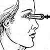 Брахитерапия глаза