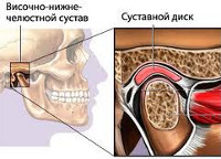 Изображение - Артроз нижнечелюстного сустава лечение 7ac0fb95c9c0dfbf994d38128ad4d10b