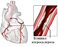 Стенокардия