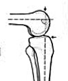Артродез плечевого сустава