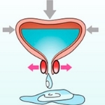 Терминальное подтекание мочи