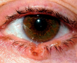 Сифилис глаза и его придатков