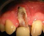 Остеомиелит после удаления зуба