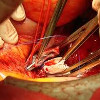 Нефрэктомия с тромбэктомией из нижней полой вены