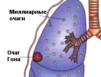 Туберкулез легких