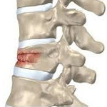 Компрессионный перелом позвоночника