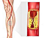 Облитерирующий атеросклероз