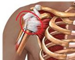Плечелопаточный периартрит рентгенологические признаки