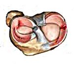 Повреждение менисков коленного сустава
