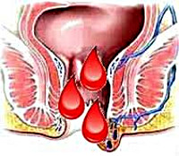 Геморроидальное кровотечение