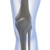 Артропластика коленного сустава