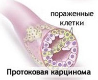 Инвазивная протоковая карцинома молочной железы лечение thumbnail