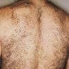 Лазерная эпиляция спины + пояса