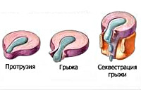 Межпозвоночная грыжа