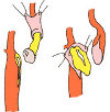 Эндартерэктомия из бедренной артерии