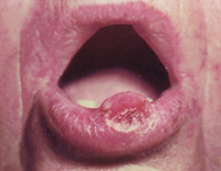 Кератоакантома губ и слизистой рта