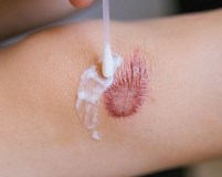 Псориатический артрит у детей Псориатический артрит у детей